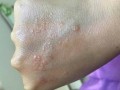 手上突然长出成群的“小水泡”，还很痒？