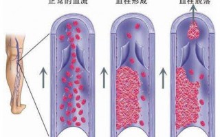 久坐可能会得静脉血栓你怕了吗？