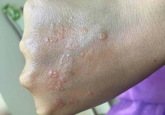 汗疱疹.jpg 汗疱疹.jpg