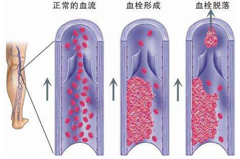 静脉血栓.jpg