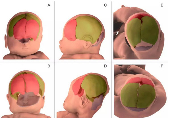 研究揭示胎儿大脑变形程度.jpg/