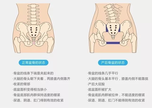 骨盆修复的宣传.jpg