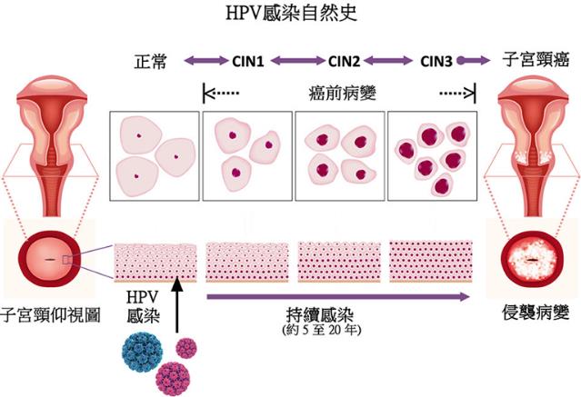 从HPV感染到宫颈癌，是个漫长的过程.jpg