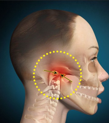 颞下颌关节紊乱.jpg