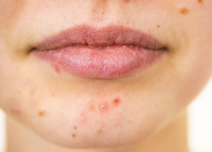 姨妈痘.jpg 姨妈痘.jpg